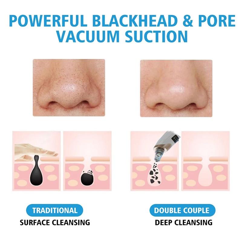 Blackhead Pore Cleaner Remover Electric Beauty Device - Inspiren-Ezone